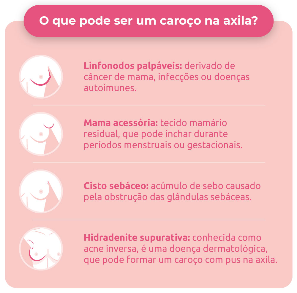 O que pode ser um caroço na axila?
Linfonodos palpáveis: derivado de câncer de mama, infecções ou doenças autoimunes.
Mama acessória: tecido mamário residual, que pode inchar durante períodos menstruais ou gestacionais.
Cisto sebáceo: acúmulo de sebo causado pela obstrução das glândulas sebáceas.
Hidradenite supurativa: conhecida como acne inversa, é uma doença dermatológica, que pode formar um caroço com pus na axila.
Lucimara Nascimento
há 7 dias