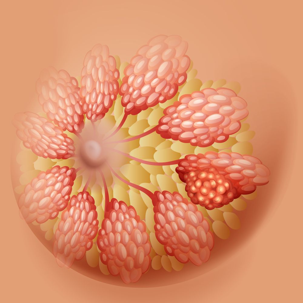 Onde fica o nódulo do câncer de mama?