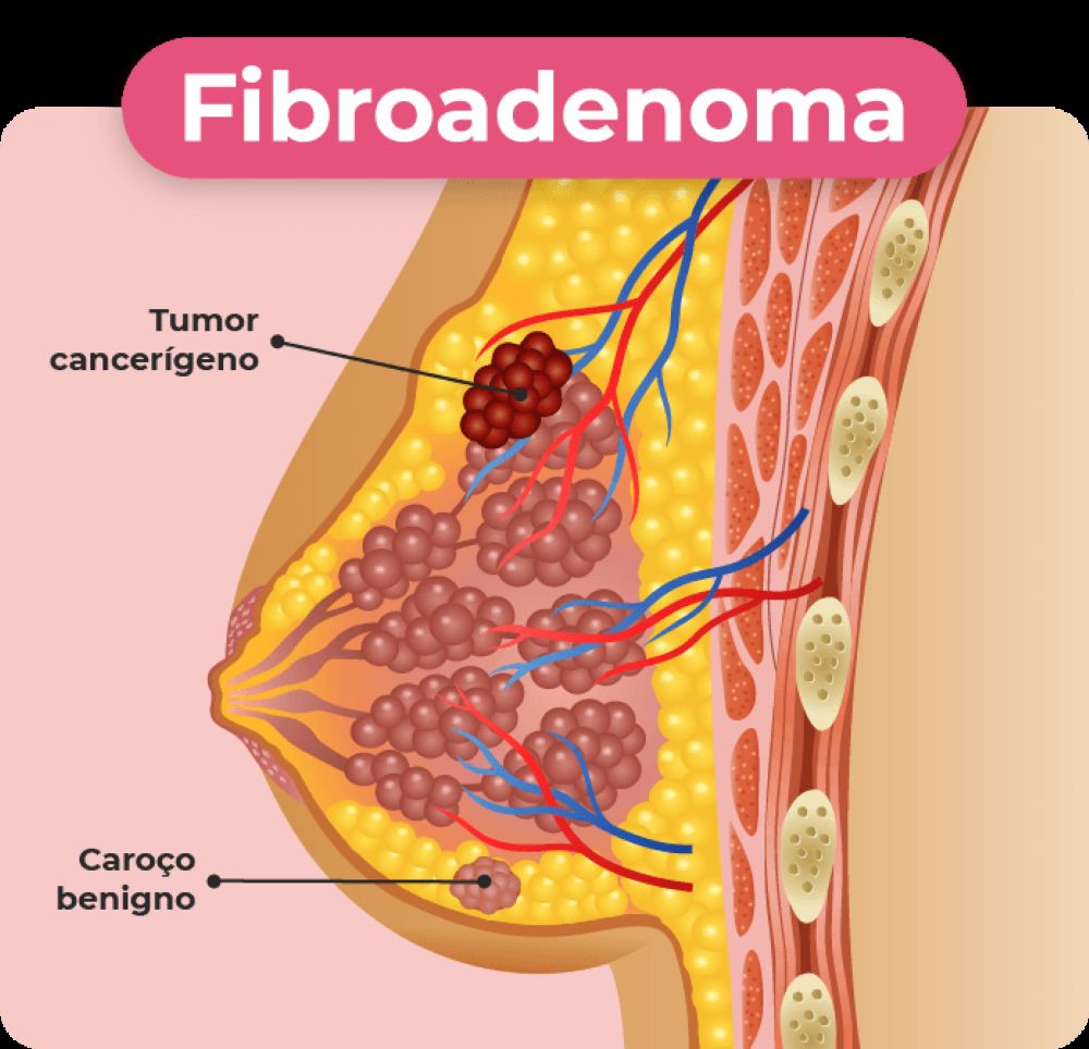Fibroadenoma: dúvidas comuns sobre esse nódulo mamário benigno