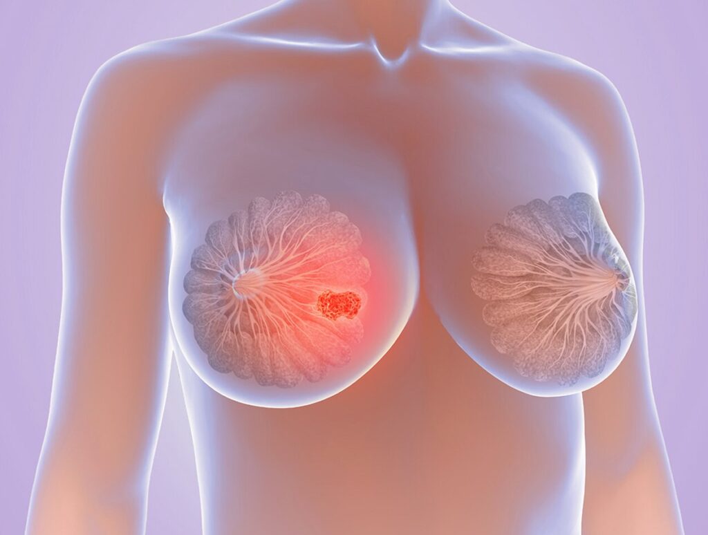Como é o caroço do câncer de mama: características que merecem atenção
