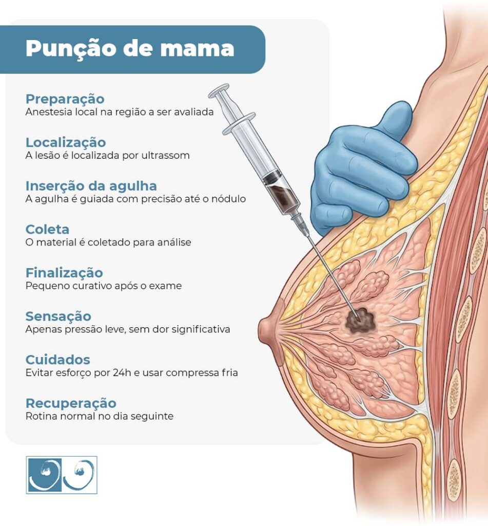A ilustração apresenta a punção da mama com agulha e, ao longo da imagem, destaca as principais etapas do procedimento