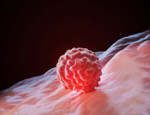 Ilustração 3D de um nódulo irregular sobre tecido mamário, representando possível tumor na mama.