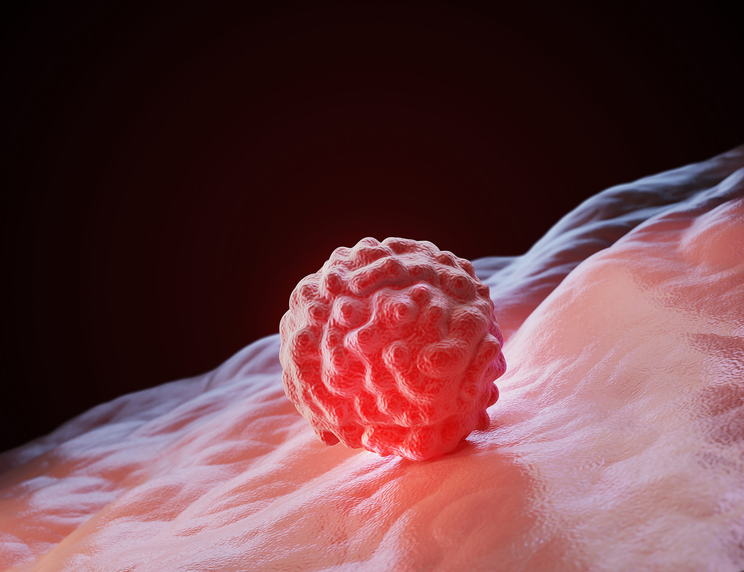 Ilustração 3D de um nódulo irregular sobre tecido mamário, representando possível tumor na mama.