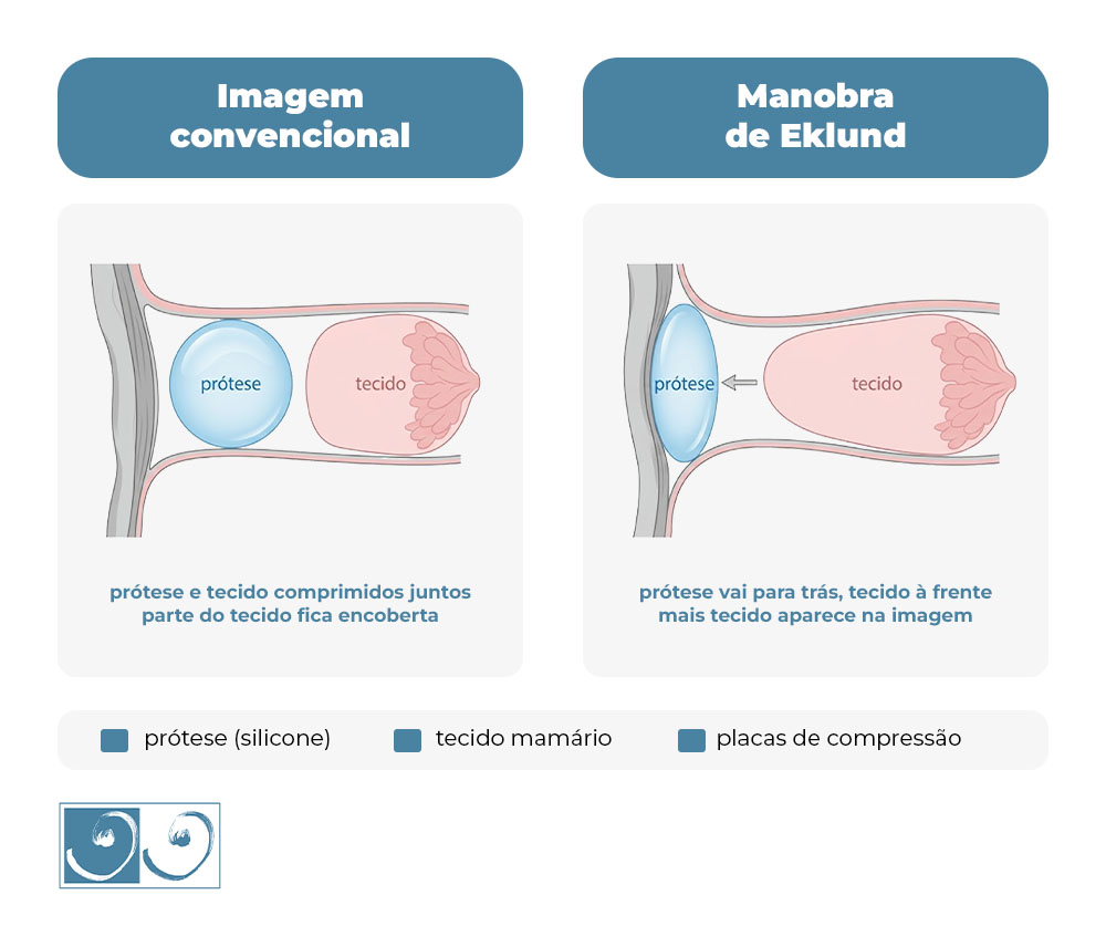 Infográfico compara a mamografia convencional com a manobra de Eklund em mulheres com prótese de silicone, mostrando como o deslocamento do implante permite visualizar mais tecido mamário.